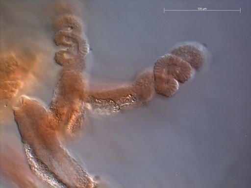 Rosacea plicata